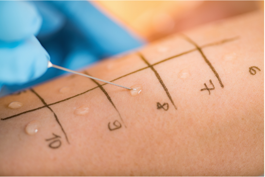 Skin Patch And Skin Prick Allergy Testing - Medika Life : Diagnostics