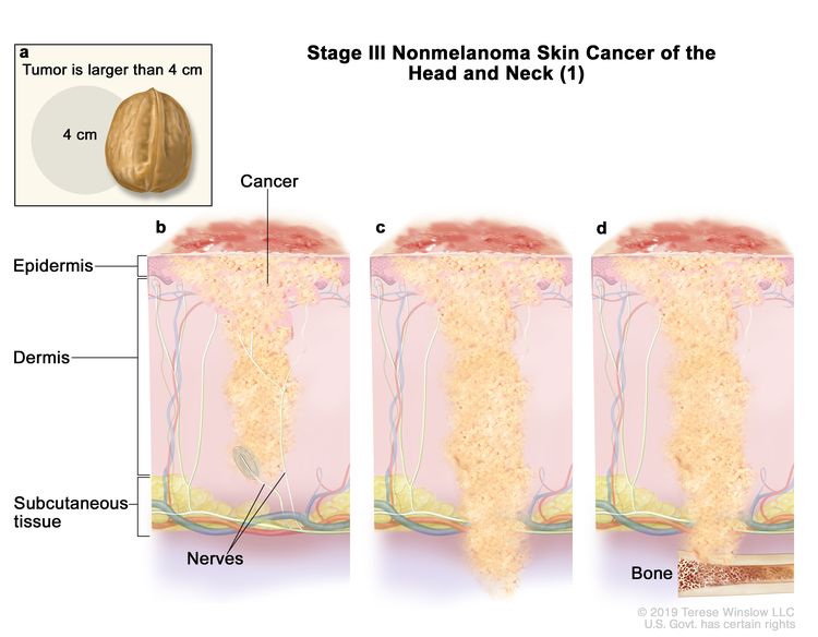 squamous-cell-carcinoma-scc-a-skin-cancer-medika-life-skin-cancer