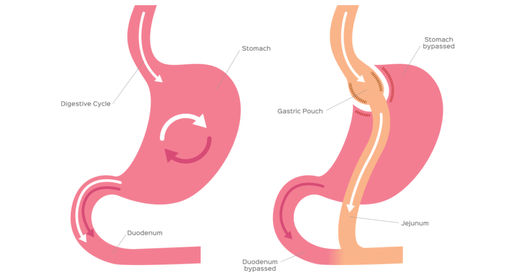 understanding-the-types-of-bariatric-surgery-medika-life-digestive