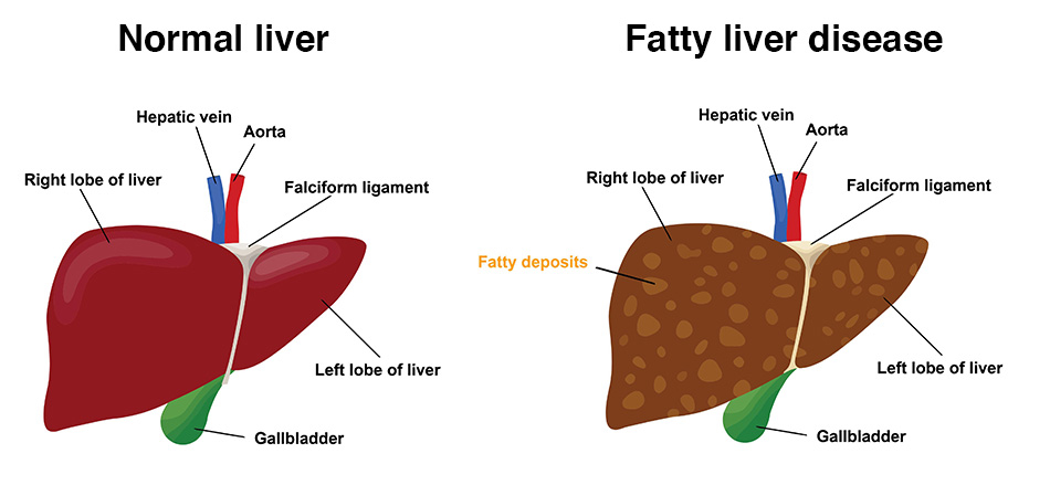 Nash And Nonalcoholic Fatty Liver Disease Nafld Medika Life