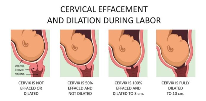 Common Methods Of Inducing Labor During Pregnancy Medika Life 